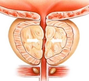 effets secondaire rabotage de la prostate