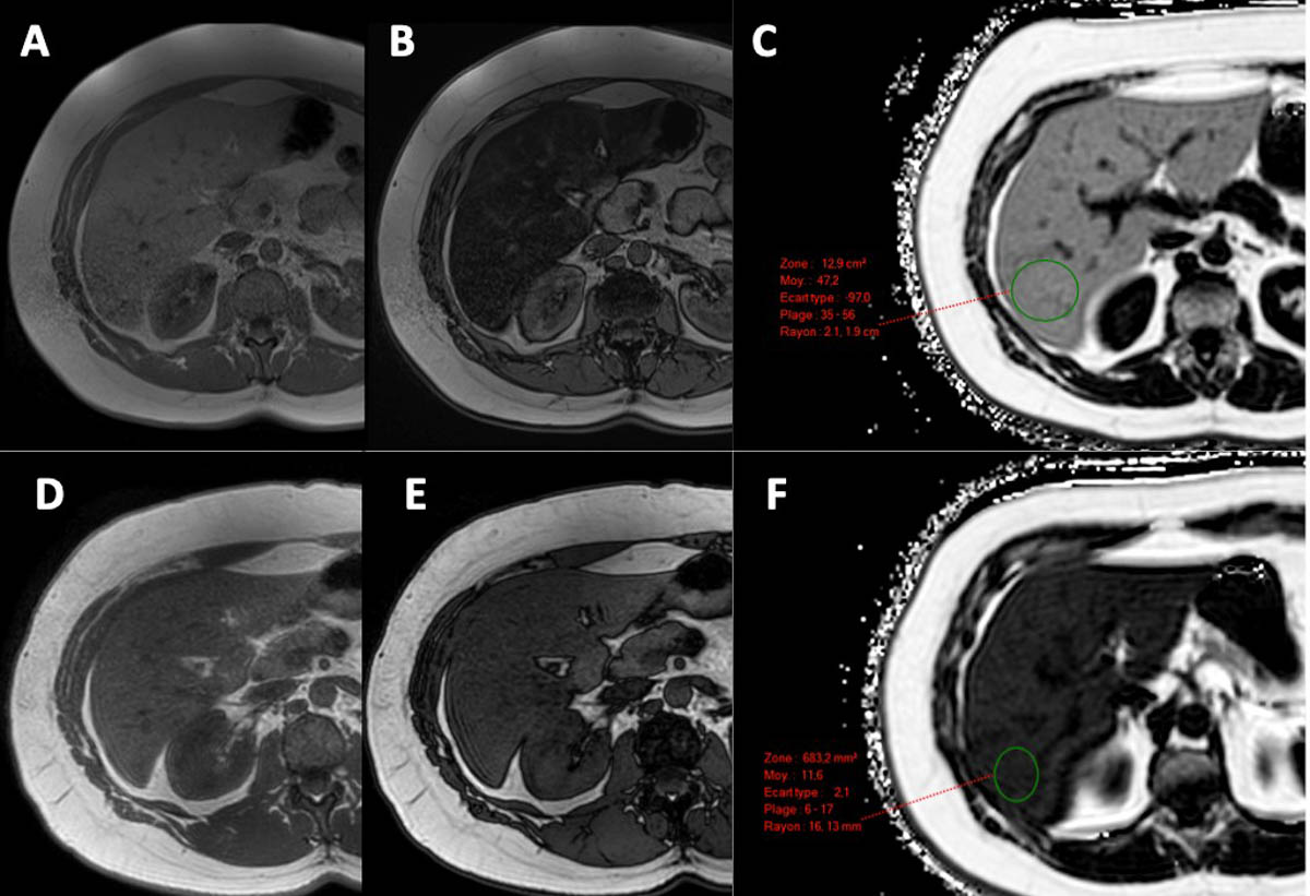 optimisez la détection précoce des maladies du foie grâce à notre algorithme innovant de dépistage. améliorez le diagnostic et le suivi médical pour une meilleure prise en charge.