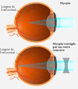découvrez comment choisir les lunettes adaptées pour corriger la myopie. conseils et astuces pour un choix optimal de correction visuelle.