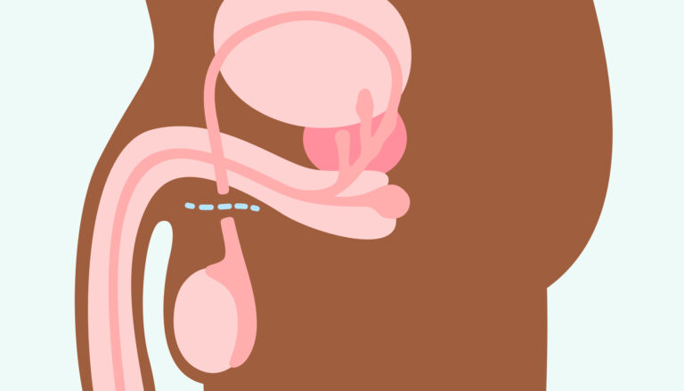 vasectomie : quels sont les avantages et les risques ?